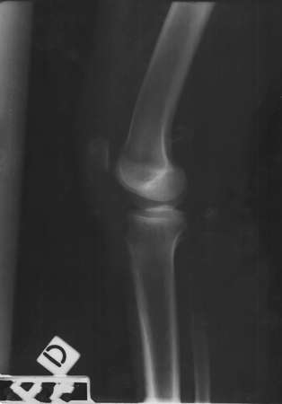 Detail of the X-ray of the bones of the human right knee.の写真素材