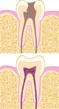 Healhy and unhealthy tooth anatomyのイラスト素材