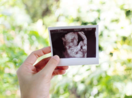 Blur image, Hand handles X-ray film with green bokeh of nature background texture.の写真素材