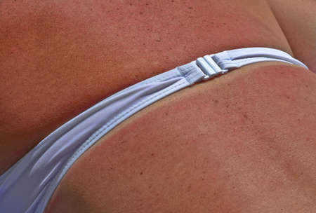 Sunburn skinの写真素材