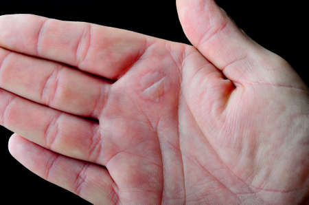 A blister on a male hand caused by a burnの写真素材
