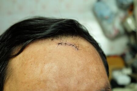 Suture sewn seven stitches on the head from accident, head injuryの写真素材