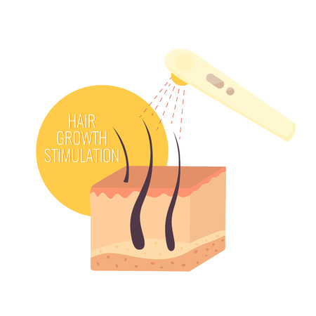 Hair growth stimulation. Red light therapy treatment. Cosmetology concept. Vector illustrationのイラスト素材