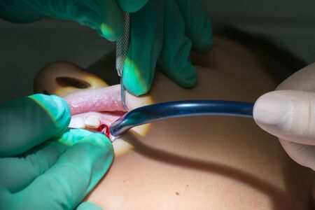 Close Up of Dentist Hands While the Inspection of Bloody Gums after the Extraction of a Decayed...