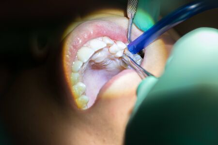 Close Up of Dentist Hand Moving a Decayed Tooth with Dental Instruments before Extraction on Blur...