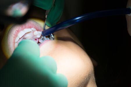 Close Up of Dentist Hand Moving a Decayed Tooth with Dental Instruments before Extraction on Blur Backgroundの写真素材