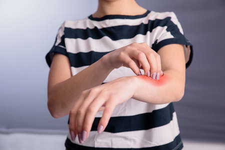 Young woman scratching her itchy arm. Skin problem.の写真素材