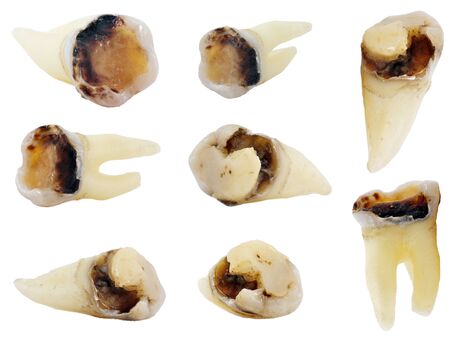 extracted carious teeth isolated on white background, set of 8 objects, high resolution