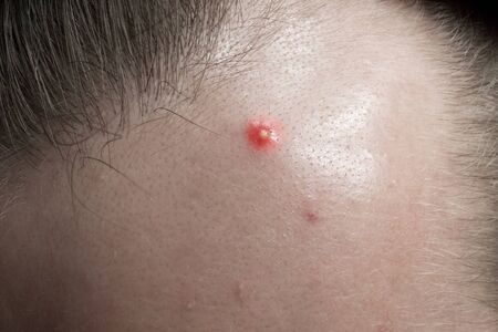 pimple on the forehead close-up, acne