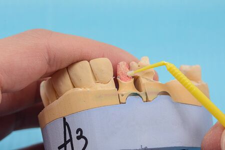 plaster models of the jaws in the hands of a dental technician in a dental laboratory, manufacturing...