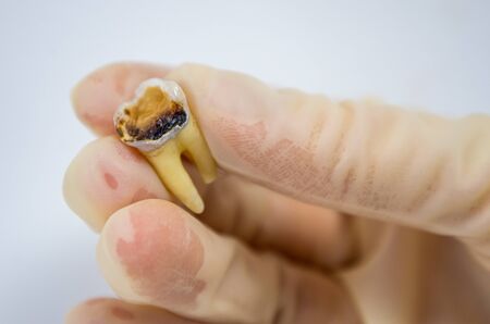 extractive caries tooth in the hand of a dentist surgeon on a white background close-up macro, upper wisdom molar, destroyed tooth fillingの写真素材
