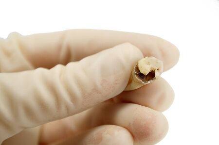 extractive caries tooth in the hand of a dentist surgeon on a white background close-up macro, upper wisdom molar, destroyed tooth fillingの写真素材