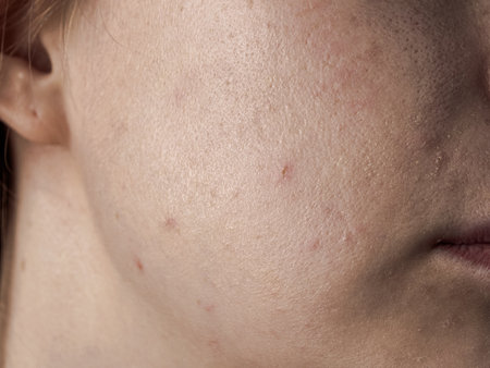 Close-up of acne skin showing problems: inflammation and rashes reflecting the condition of the face.の写真素材