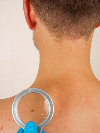 Skin examination by a dermatologist: examination of moles and formations to diagnose and evaluate...