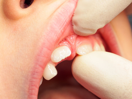 Milk bite and tooth change in children, the process of tooth growth and change in early childhood, close-up.の写真素材