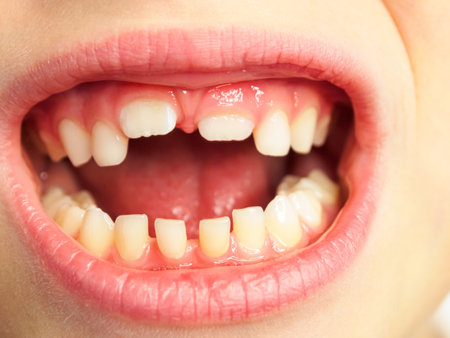 Milk bite and tooth change in children, the process of tooth growth and change in early childhood, close-up.の写真素材