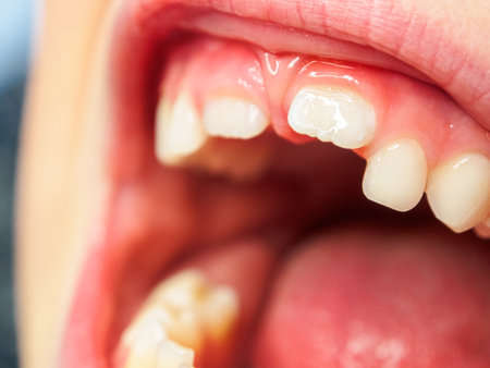 Milk bite and tooth change in children, the process of tooth growth and change in early childhood,...