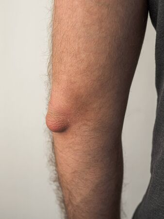 Man with painful elbow or with inflammation of joint. Man in gray t-shirt with painful swelling elbow in natural daylight.の写真素材