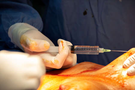 Hands of the doctor close up during the operation, in the hands of a syringe that makes an injection in the patient's area. A surgeon performs surgery in a hospital operating room. Breast surgery.の写真素材