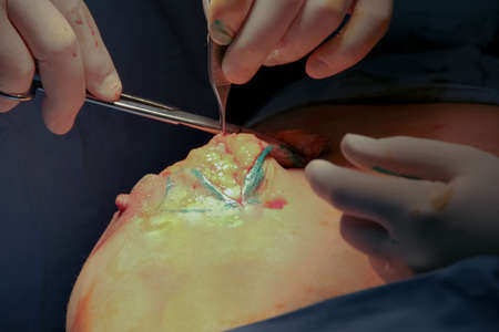 Close-up of breast augmentation surgery in the operating room.の写真素材