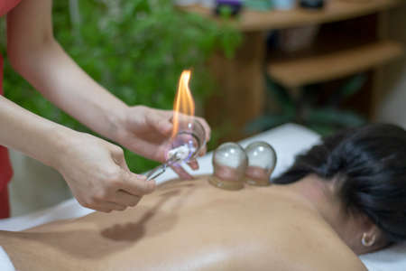Acupuncture therapist removing a fire cupping glass from the back of a young womanの写真素材