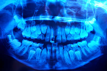 Twelve-year old boy panoramic dental x-rayの写真素材