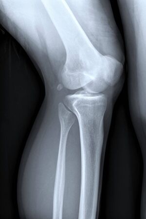 X-ray of a kneeの写真素材