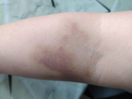 Extreme close up of a human arm featuring a large deep purple and yellowish hematoma bruise on the...
