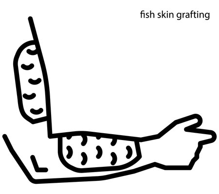 Fish skin grafting for wound healingのイラスト素材