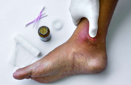 Abscesses form after bacteria. Doctor cleans purulent wound on patients foot.の写真素材