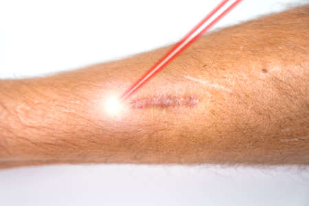 Man leg and laser beam during scar removal treatment.の写真素材