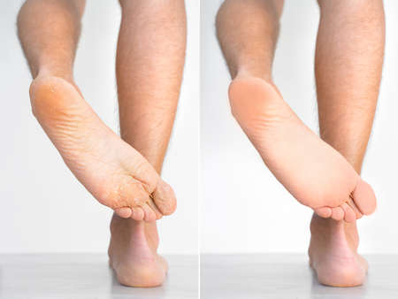 Mans feet with dry skin before and after treatment. Fungal infection or athletes foot, dry skin, dermatitis, eczema, psoriasis or sweaty feet. Health care conceptの写真素材
