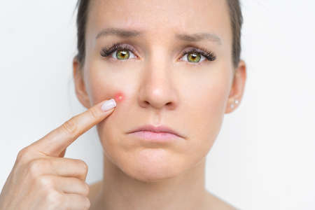 Close up portrait of beautiful sad unhappy woman face with pimple on her cheek. Acne, problem skin. Face skin care. Facial treatment. Cosmetology, beauty and spaの写真素材