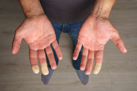 Man showing hands with Raynaud syndrome, Raynauds phenomenon or Raynauds diseaseの写真素材