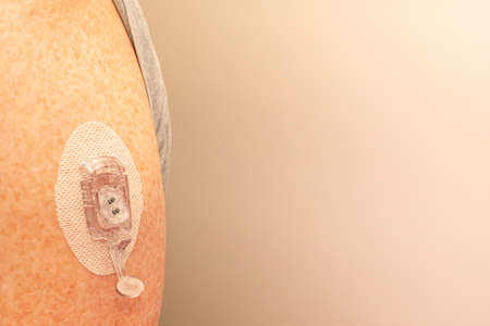 CGM - Continuous glucose monitoring: sensor installation on the upper arm. Sensor pod and transmitter latch. Diabetesの写真素材