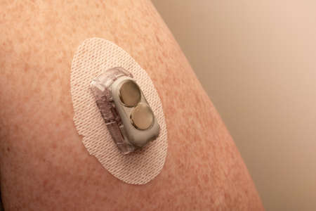 CGM - Continuous glucose monitoring: sensor installation on the upper arm. Sensor pod and...