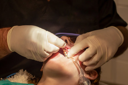 Bonding of dental braces and expander. Orthodontic treatment. Dentist put on arch wire on metal brackets. Girl with open mouth at the dental chair.の写真素材