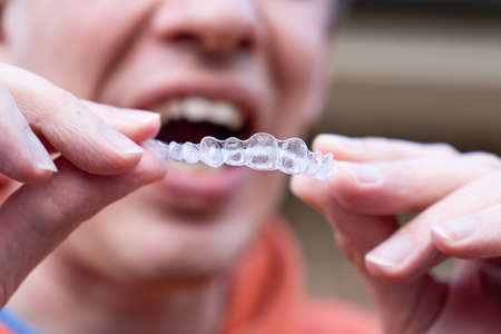 Man holding put on invisible braces. Orthodontic dental braces teeth straighteners treatment. Gap between front teeth.の写真素材