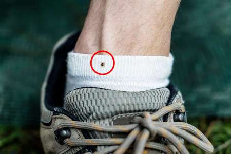 Australian bush tick sitting on a sog on a human leg. Cattle tick dangerous to human. Hiking.の写真素材