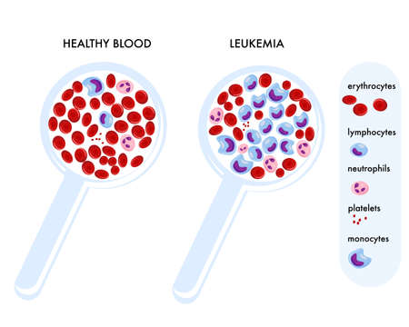 Magnifying glass with normal blood and with leukemia.のイラスト素材