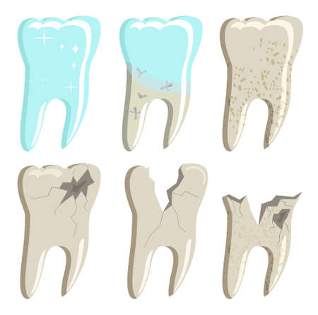 Different stages of decayed teeth with caries and plaque.Oral cavity disease.Root canal filling.Template for dentistry officeMolars with cracks and holes. Damaged enamel problems. Orthodontics clinicのイラスト素材