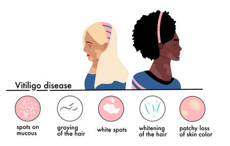 World vitiligo day.Young women different ethnicities with skin disease.Depigmentation problem.Patchy loss of derma color.Infographics icons with symptoms and signs of autoimmune sickness.Vector bannerのイラスト素材