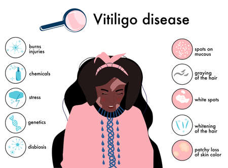 World vitiligo day.Infographics icons with symptoms and reasons of autoimmune sickness.Skin disease.Afro american woman with white spots.Depigmentation problem.Patchy loss of derma color.Vector bannerのイラスト素材