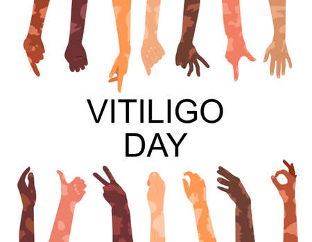 World vitiligo day poster.Hands different ethnicities in various gestures with skin disease. Depigmentation problem. Patchy loss of derma color. White spots. Autoimmune sickness. Human Solidarity.のイラスト素材