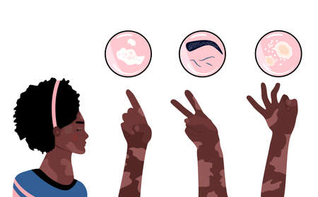 World vitiligo day.Young afro american woman with skin disease.Hands show 1,2,3 fingers. Pigmentation problem.Patchy loss of derma color. Infographics icons with symptoms,signs of autoimmune sicknessのイラスト素材