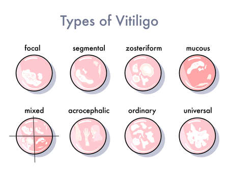 Types of vitiligo infographic icons Options for the spread and manifestation of the skin disease.Pigmentation problem.Patchy loss of derma color.   Vector in flat style. Psoriasis. Medical bannerのイラスト素材