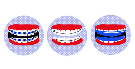 Dental braces, essix aligner or orthodontic Hawley retainer on teeth.Poster in pop art style.Oral care and daily routine.Bite correction.Cavity disease.False jaw.Bruxism treatment.Vectorのイラスト素材