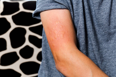 Red rash on skin from allergic reactions. Health care and medical concept, selective focusの写真素材