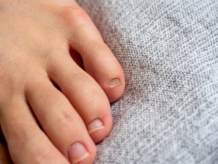 close up of a woman's foot with problems on the nails lying on a gray blanketの写真素材