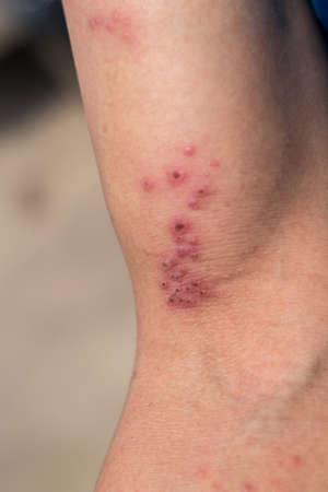 Raised red bumps and blisters caused by shingles on skinの写真素材